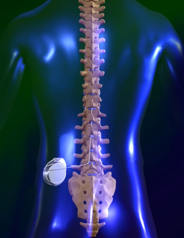 Spinal Cord Stimulator II