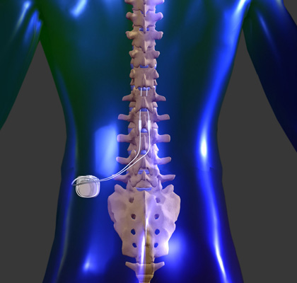 Spinal Cord Stimulator Trial